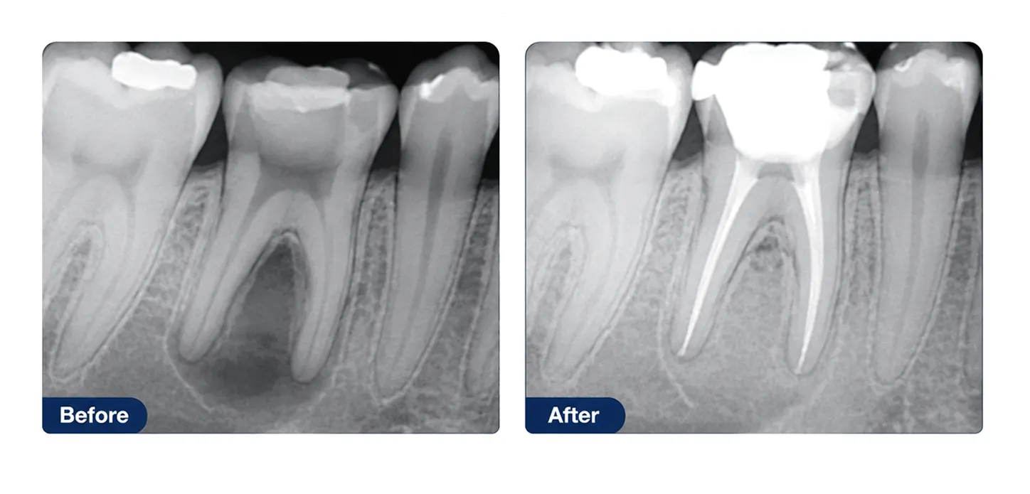 Endodontics clinical examples