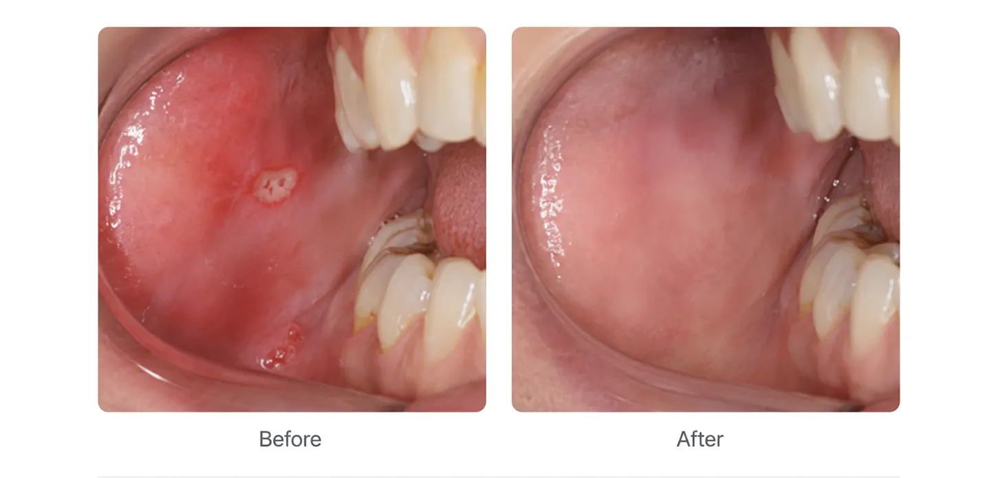 Dental PBM clinical examples