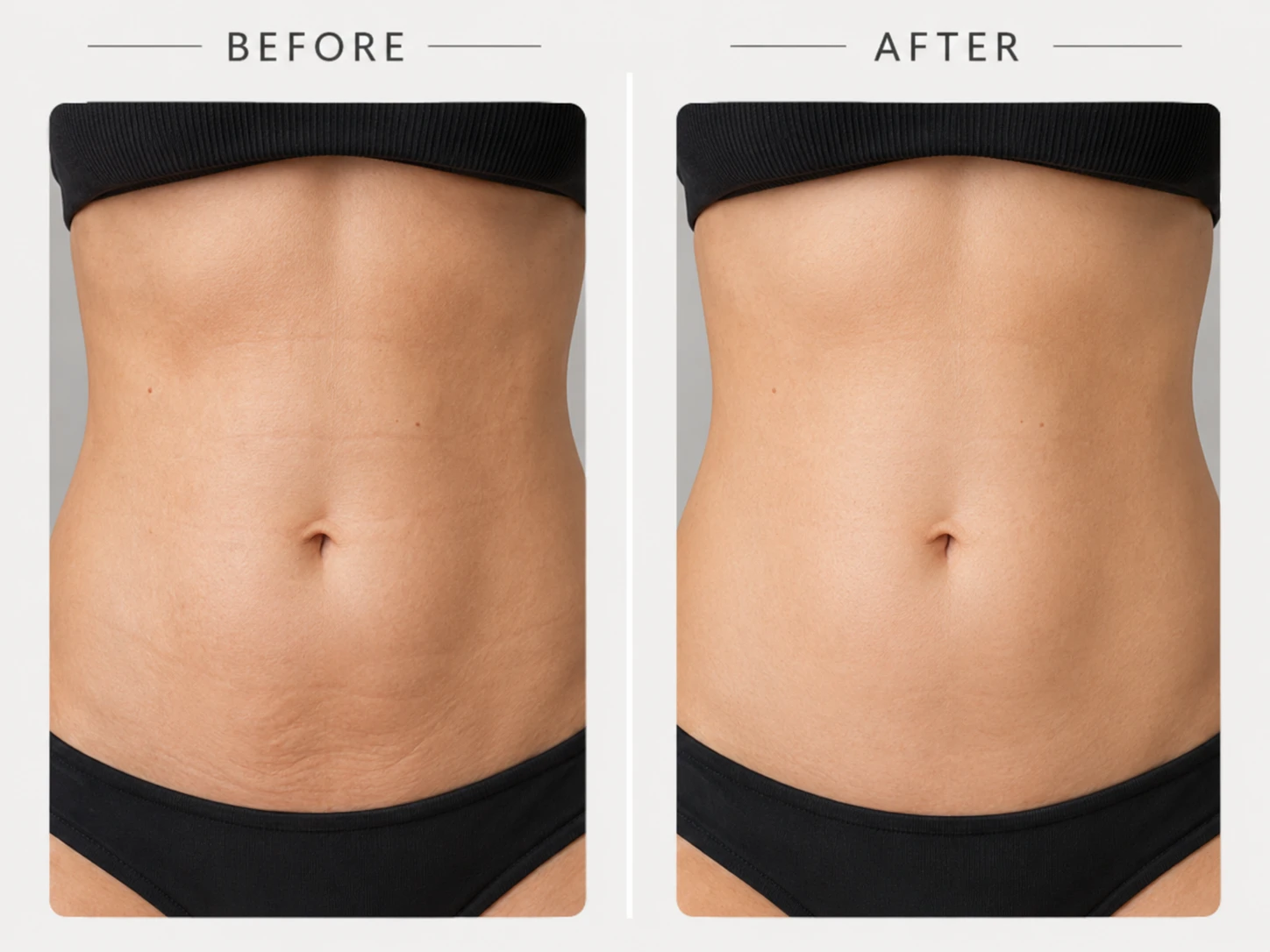 Abdominal laser lipolysis before and after comparison