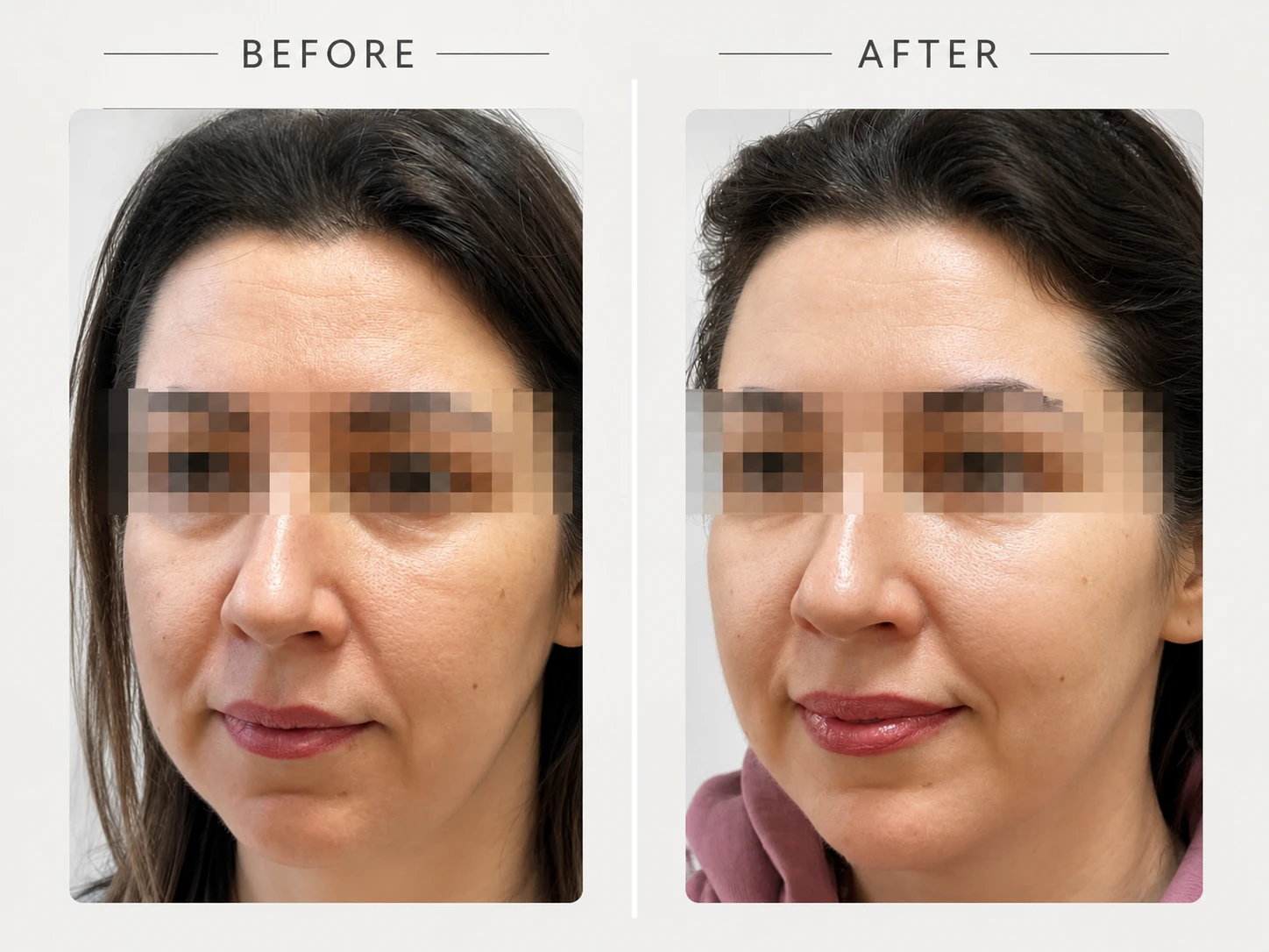 Laser Facelift