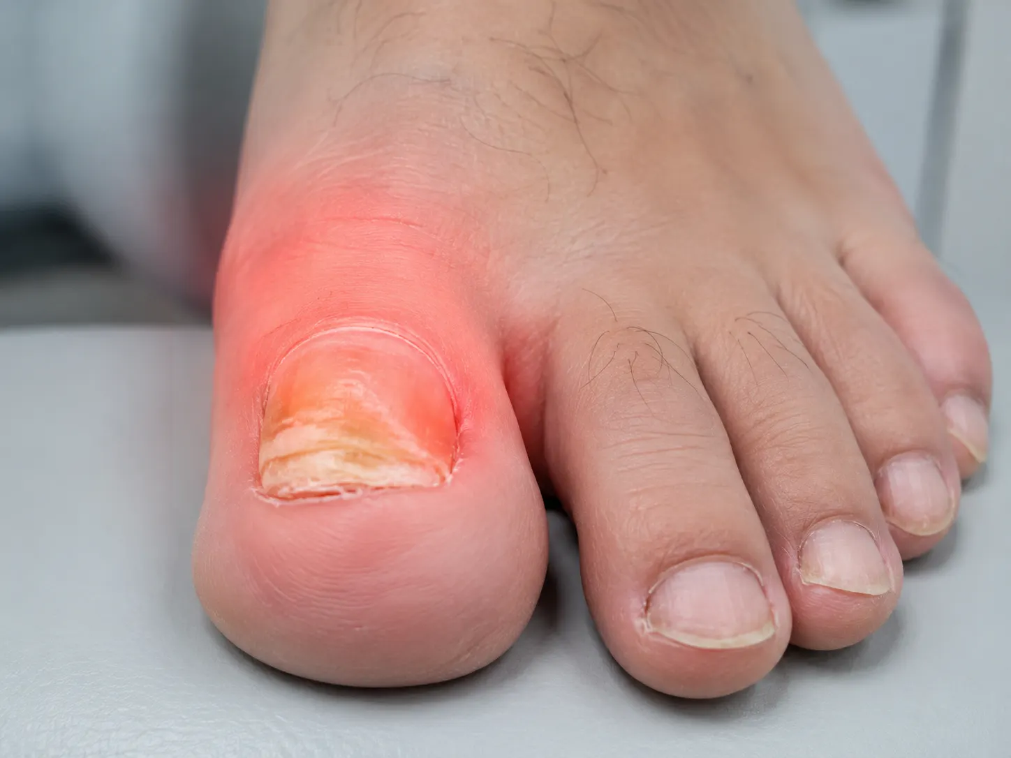 Podiatry laser support for onychomycosis