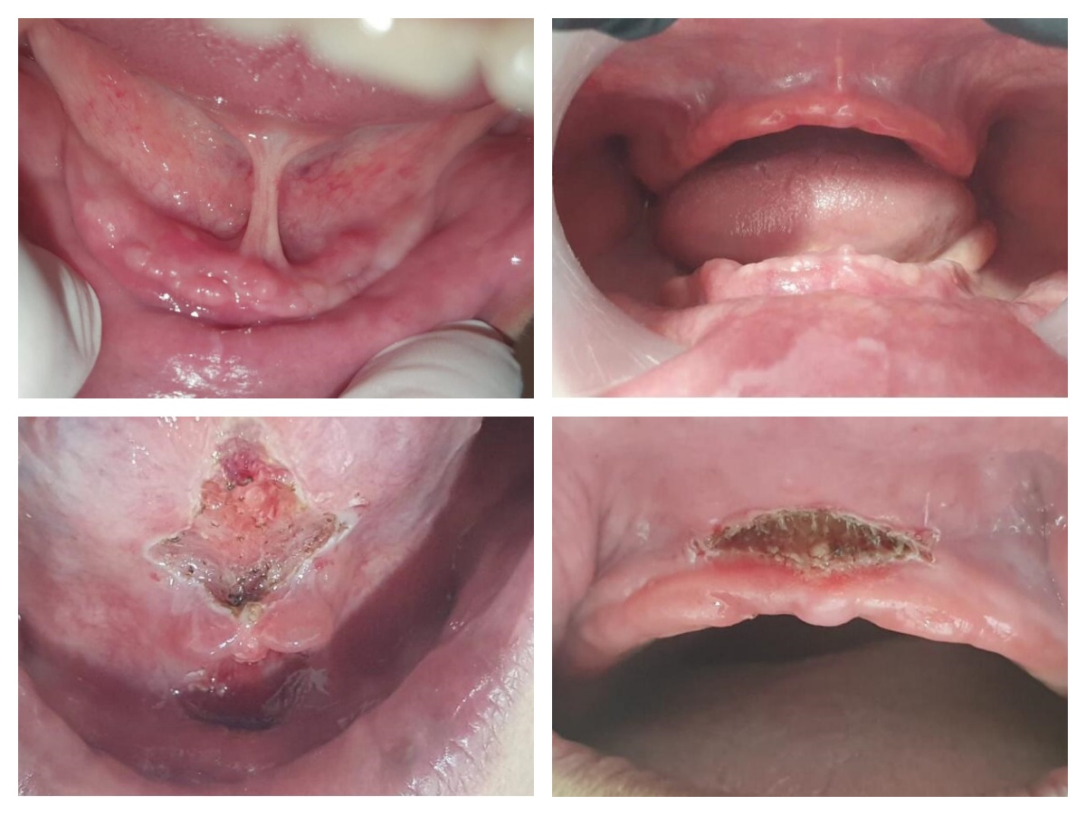 Clinical Advantages of Dental Laser Treatment