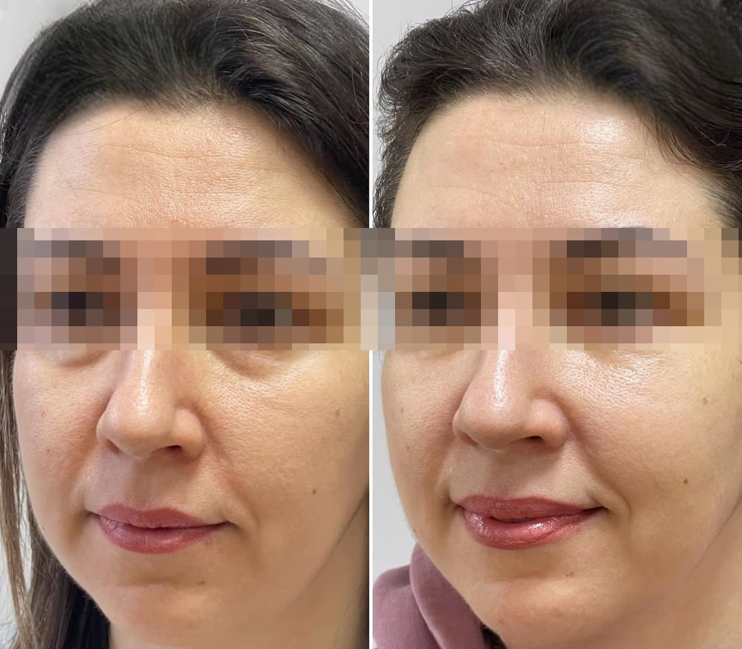 Clinical advantages of laser facelift treatment including non-invasive skin tightening