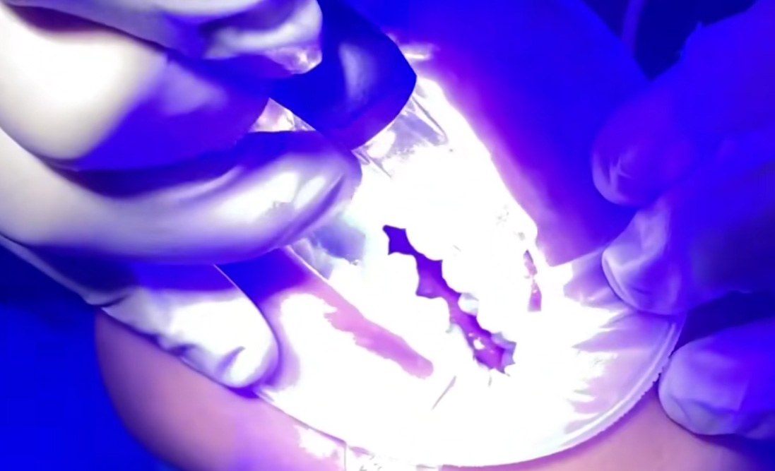 Clinical Benefits of 450nm Blue Laser in Oral Surgery